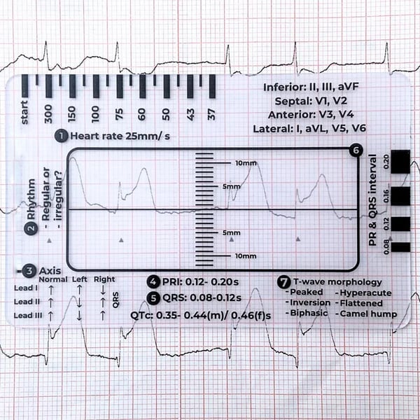 EKG Pocket Guide