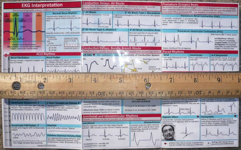 EKG Pocket Guide
